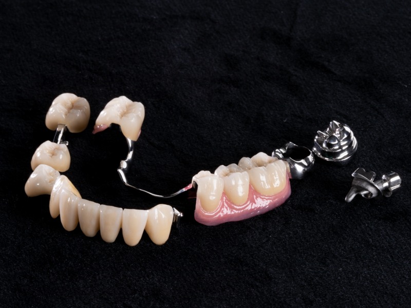 Prothèse dentaires partielle
