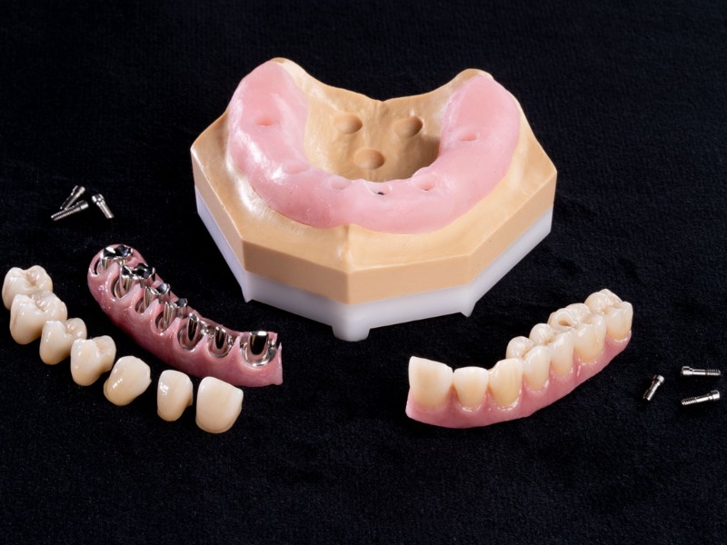 Prothèse dentaires complète