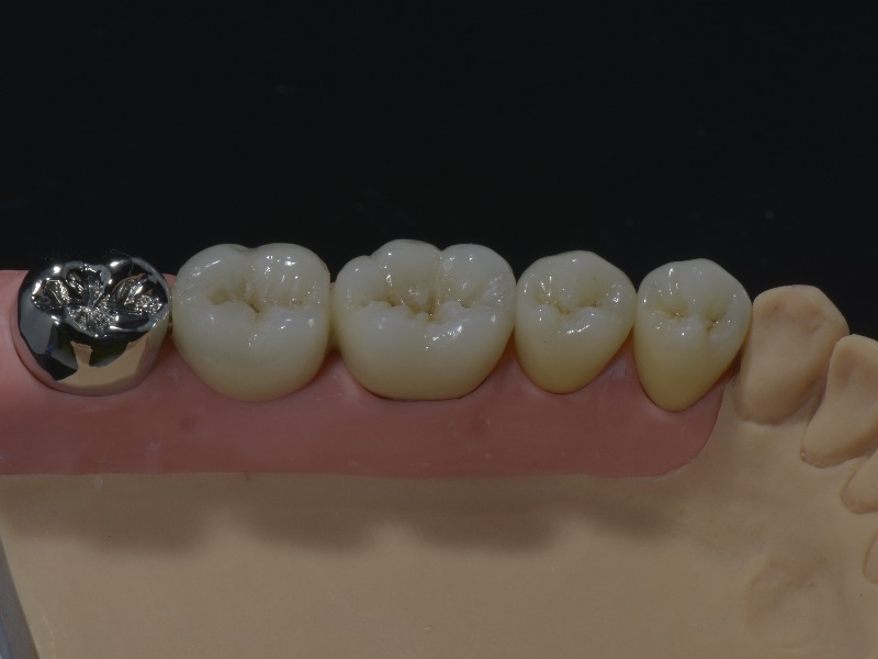 Couronne dentaire métal_2